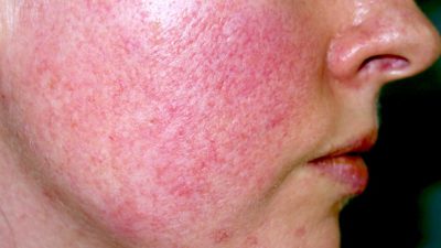 نشانه ها و علائم روزاسه بر روی پوست