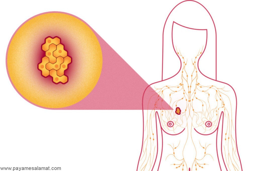 آشنایی با مهمترین اثرات سرطان پستان بر روی بدن
