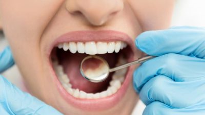 روش های درمان کرم خوردگی دندان
