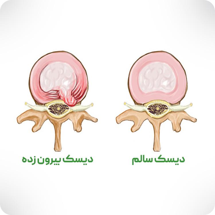 تصویری از یک دیسک سالم در مقایسه با دیسک بیرون زده.