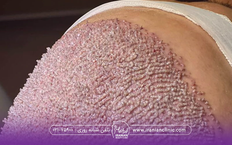 فردی که کاشت مو انجام داده است