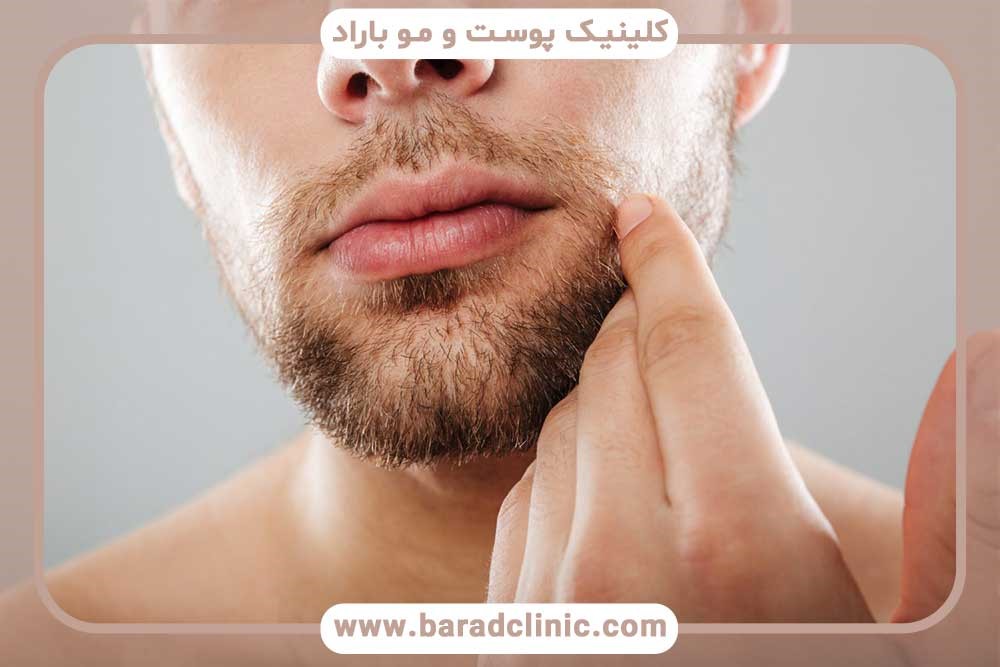 بهترین کلینیک کاشت ریش در تهران