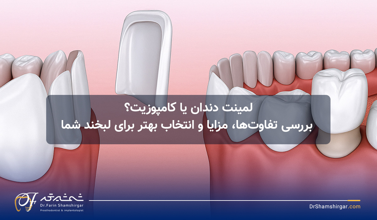لمینیت دندان
