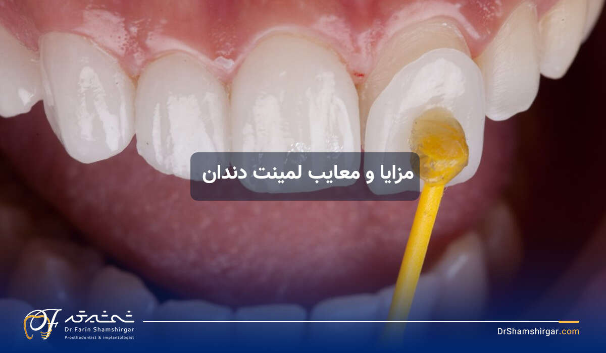 مزایا و معایب لمینیت دندان